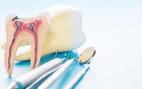 What Are Root Canals