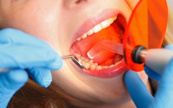 What Is Dental Bonding