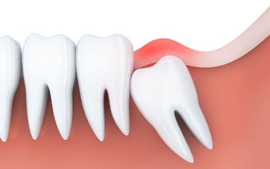 What Is Wisdom Teeth Removal
