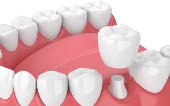 illustration of a dental crown procedure