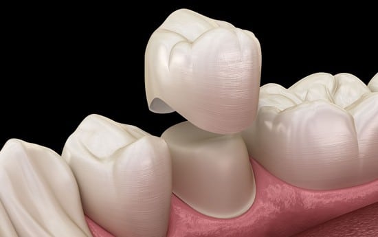 Procedure For Dental Crowns