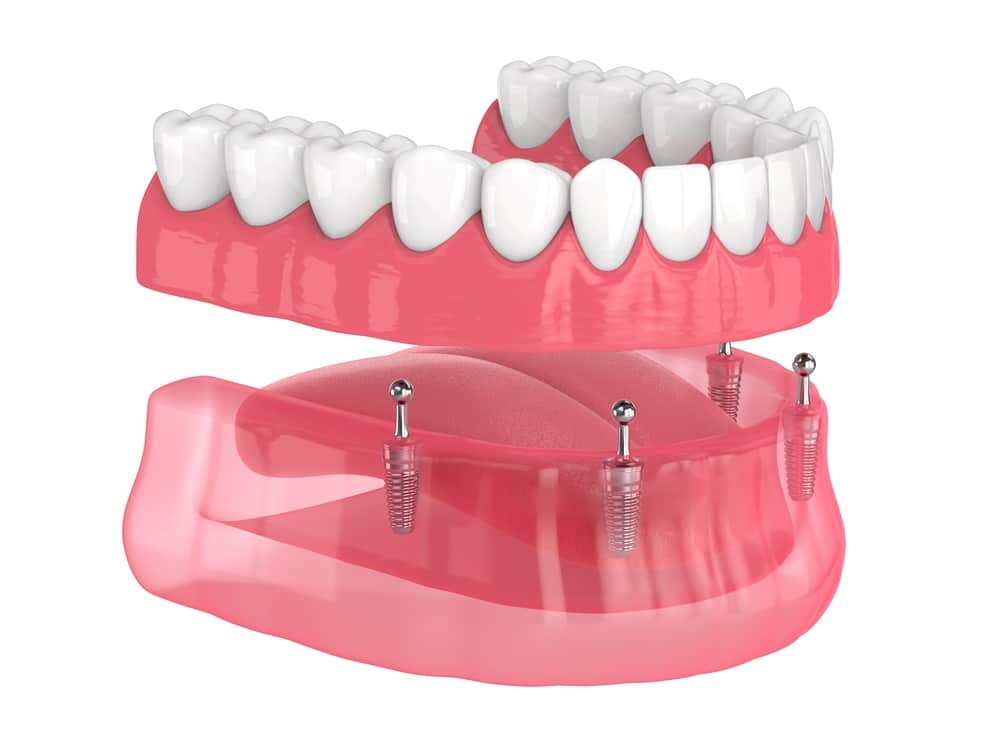 all-on-4 dental implants in Burleson, TX