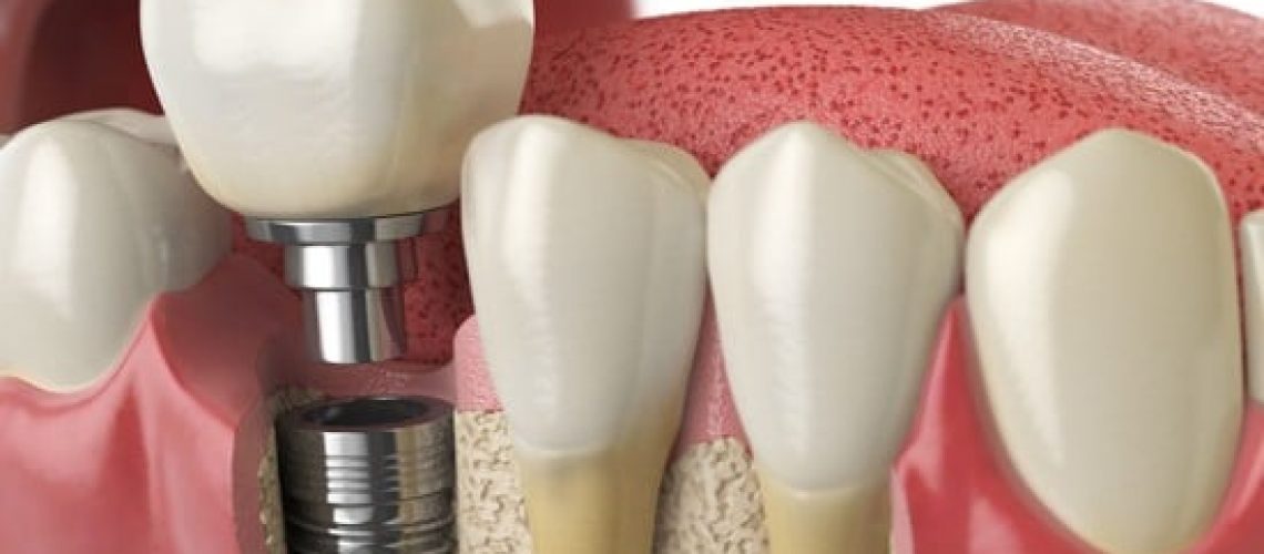 dental implants in burleson, tx